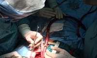 انجام عمل کم نظیر قلب باز CABG به روش توتال ارتریال  برای اولین بار در فسا